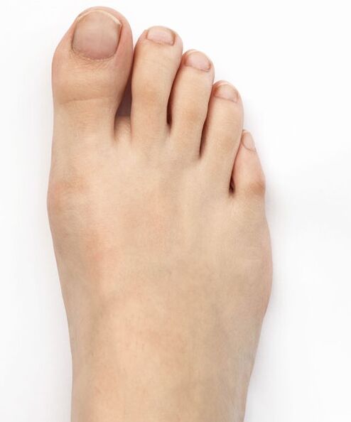 I cured my thumb warts with Hondro Sol Valgus spray