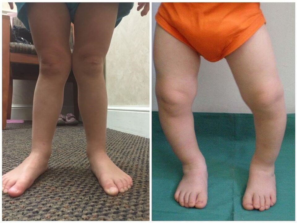 Valgus deformation in children
