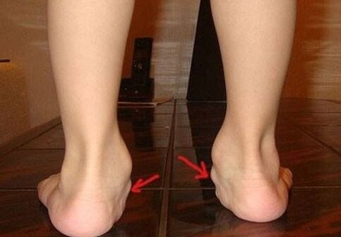 Valgus deformation of legs in children
