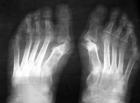 Signs of operations under the foot