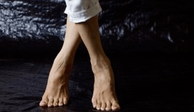 Valgus deformation