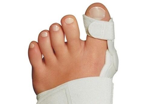Valgus deformation
