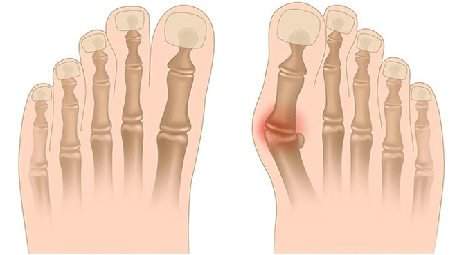 Treatment of Valgus deformation