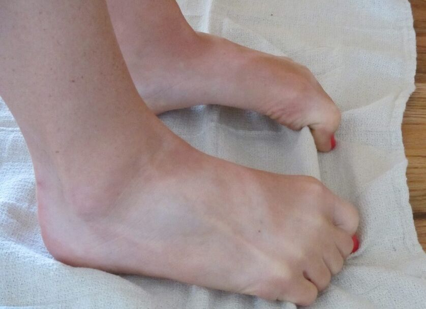 Exercise for feet with deformed big toes