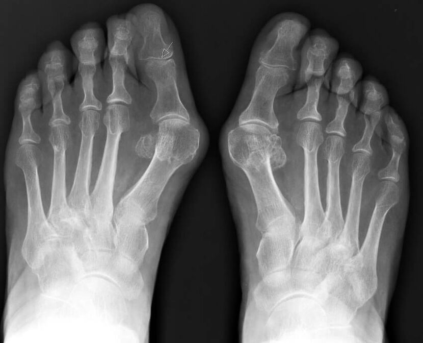 X-ray hallux valgus